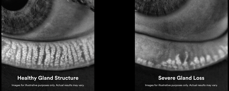 Side by side photo of healthy and unhealthy eye gland.